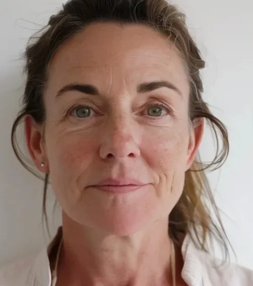 microneedling-before-after-0004