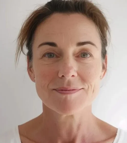 microneedling-before-after-0005